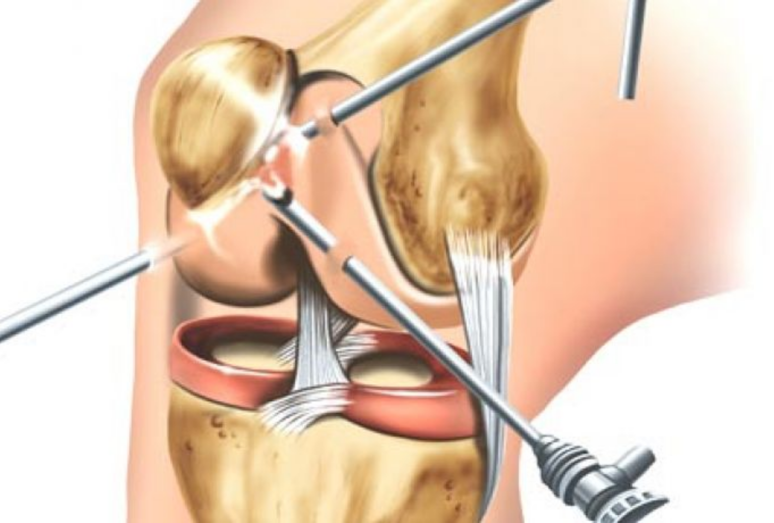 Líquido en rodilla después de artroscopia